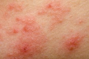 9 remedii naturiste pentru rozacee