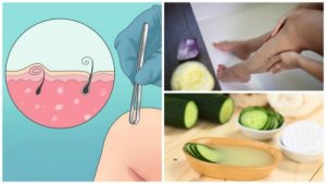 Firele de păr crescute sub piele: 5 soluții naturale