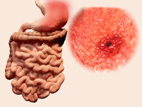 Gazele pot fi un simptom al ulcerului gastroduodenal
