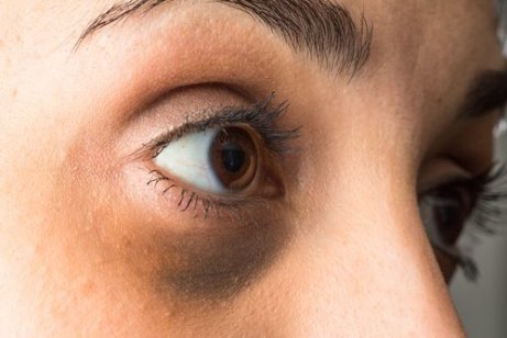 Cum combați cercurile negre din jurul ochilor prin metode naturale