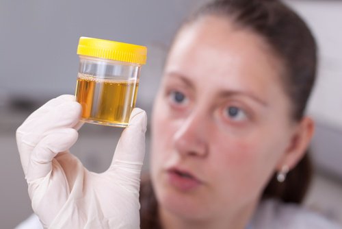 Culoarea urinei poate indica necesitatea unui consult medical