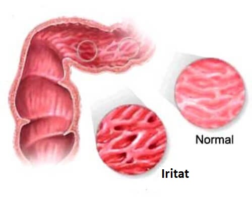 Sindromul de colon iritabil – 4 trucuri pentru a-l trata