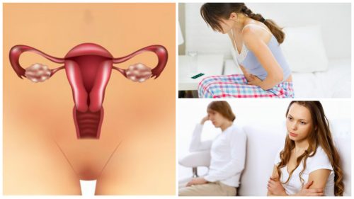 Sindromul ovarelor polichistice: 7 informații importante