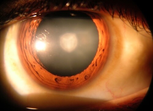 8 informații importante despre cataractă