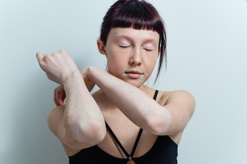 Există remedii naturale pentru vitiligo pe bază de lămâie