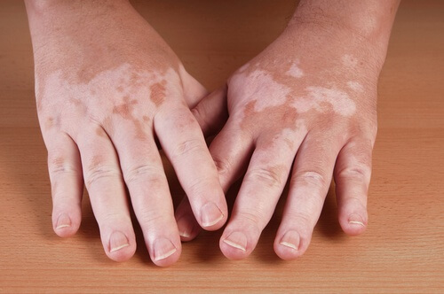 Vitiligo afectează persoane de toate vârstele