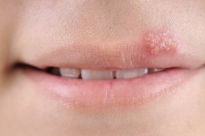 5 remedii naturale pentru herpes