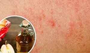 7 remedii pentru ciupercile pielii