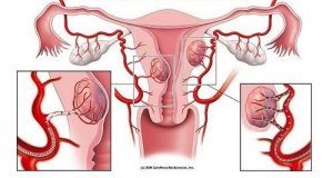 cum să readuceți libidoul în prostatita cronică ceai prostatic larix