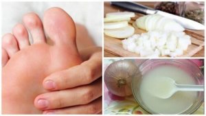 Tratament naturist pentru pielea îngroșată de pe tălpi