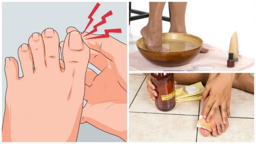 Tratează unghiile încarnate cu 6 remedii naturale