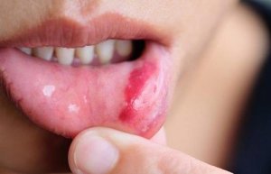 Cancerul oral: simptome, factori de risc și prevenire