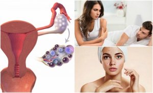 7 simptome ale sindromului ovarelor polichistice