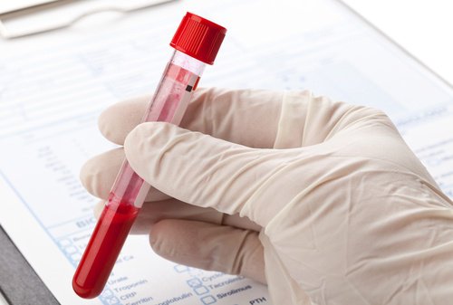 Hemocromatoza intră în categoria de cauze ale insuficienței congestive