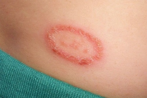Herpesul circinat provoacă erupții circulare