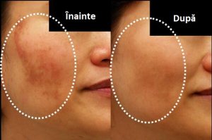 5 măști pentru a trata melasma
