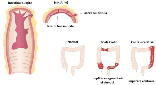 Moduri de a trata boala Crohn ce afectează intestinele