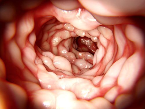 Principalele moduri de a trata boala Crohn
