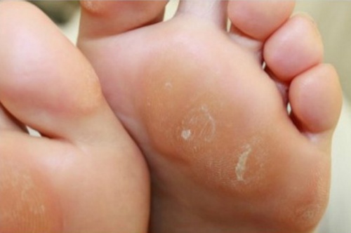 ciuperca unghiilor de la picioare poate fi vindecată cu oțet
