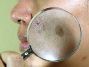 7 remedii naturiste împotriva melasmei