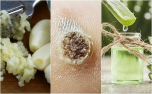 5 remedii naturiste împotriva negilor