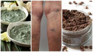 6 remedii naturiste împotriva varicelor