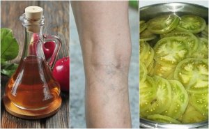 Remediu naturist pentru varice cu oțet și roșie verde