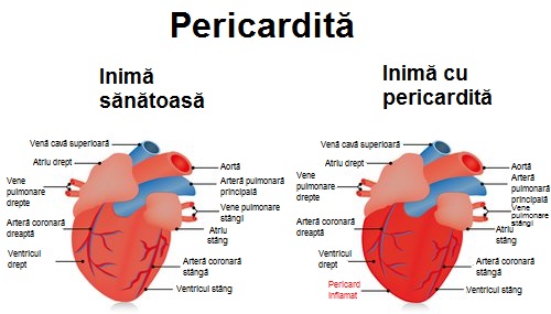 Ce este lupusul eritematos sistemic ce provoacă pericardită