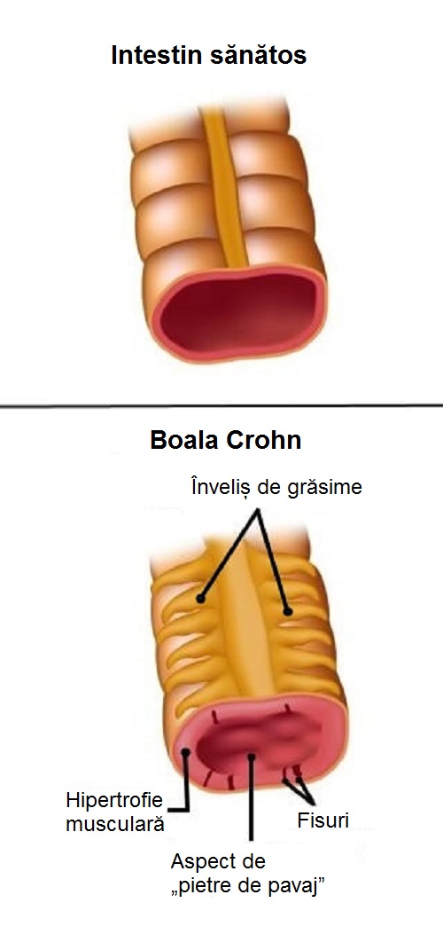 Informații despre boala Crohn și cum se manifestă ea