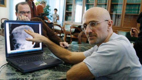 Primul transplant de cap realizat de neurochirurgul Sergio Canavero