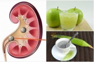 Dizolvarea pietrelor la rinichi cu infuzii și sucuri naturale