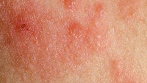 Roșeața printre simptome ale cancerului de piele