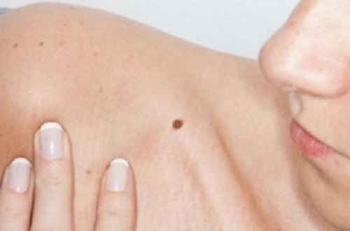Simptome ale cancerului de piele ca alunițele neregulate