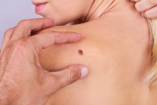 6 simptome ale cancerului de piele
