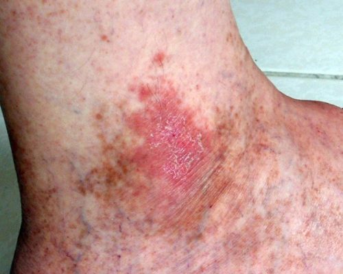 Simptome ale cancerului de piele foarte vizibile