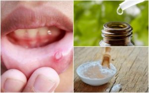 Tratează aftele bucale cu 6 remedii naturale