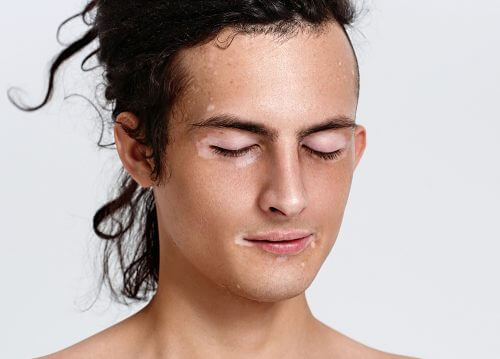 Ce este vitiligo și care sunt cauzele apariției sale
