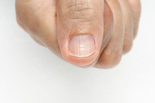 Eliminarea dungilor de pe unghii în funcție de cauză