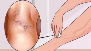 8 exerciții pentru a trata varicele