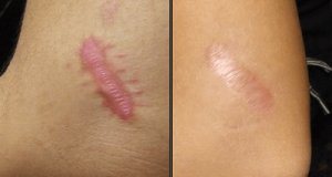 5 remedii naturiste pentru cicatricile cheloide