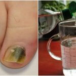 tratament cu propolis pe alcool pentru ciuperca unghiilor)