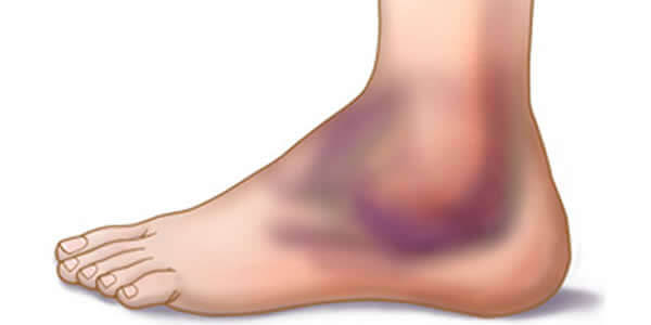 artrita pe degetul de la picior spray de artrită articulară nano