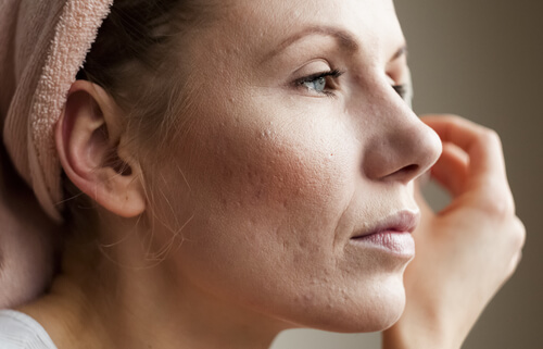 Simptome ale nivelului ridicat de cortizol pe pielea unei femei