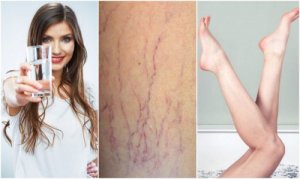 6 trucuri pentru prevenirea varicelor