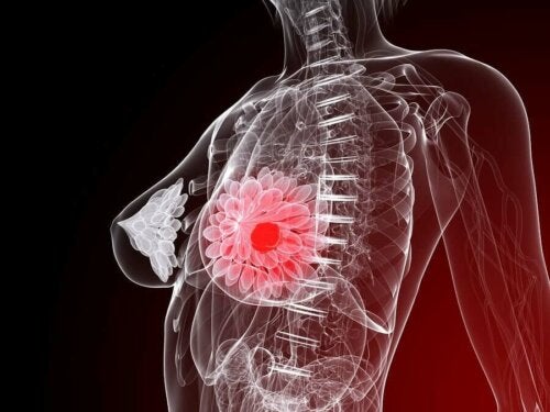 Tumoare la nivelul sânului unei femei