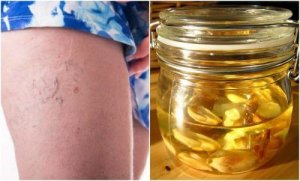 Tratarea venelor în pânză de păianjen cu un unguent