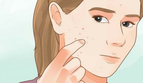 Acneea cauzată de dezechilibre hormonale ce afectează aspectul fizic