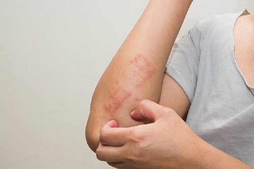 Petele roșii sau vineții pe piele ca simptome ale leucemiei
