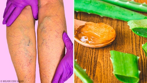 Remediu pentru varice cu aloe vera
