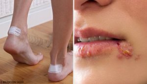 5 remedii naturale pentru bășici
